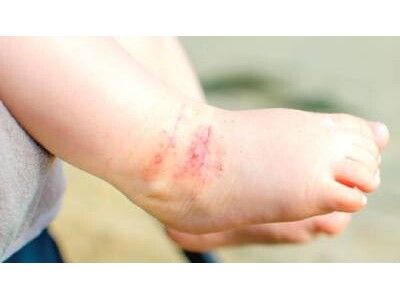 Атопический дерматит у детей (детская экзема)