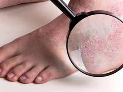 Ксероз - причины появления и лечение чрезмерной сухости кожи 