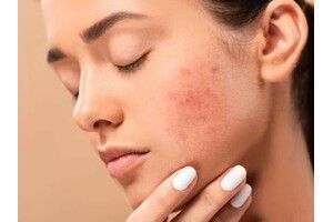 Постакне: как эффективно бороться и восстанавливать кожу