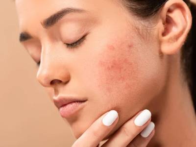 Постакне: как эффективно бороться и восстанавливать кожу