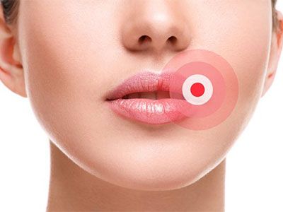 Заеды в уголках рта или ангулит - почему появляются и как лечить