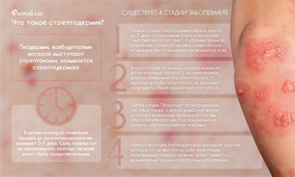 Что такое Стрептодермия?