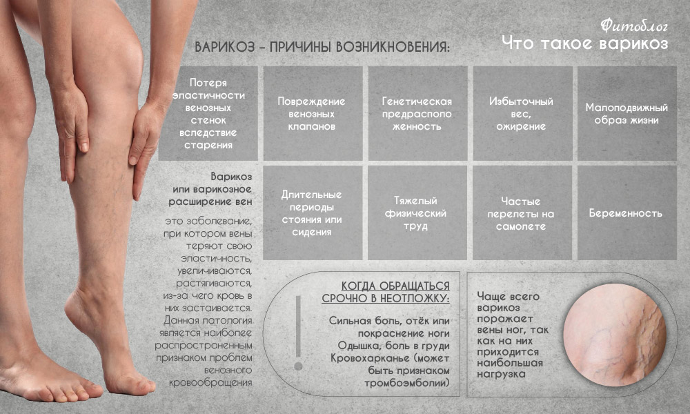 Что такое варикоз и чем его лечить