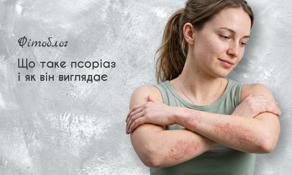 Що таке псоріаз і як він виглядає