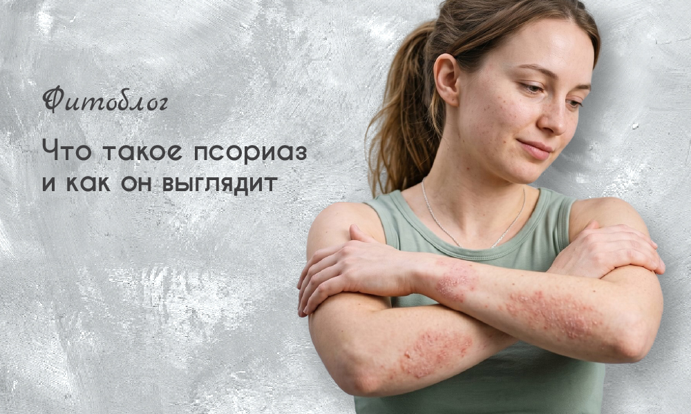Что такое псориаз и как он выглядит