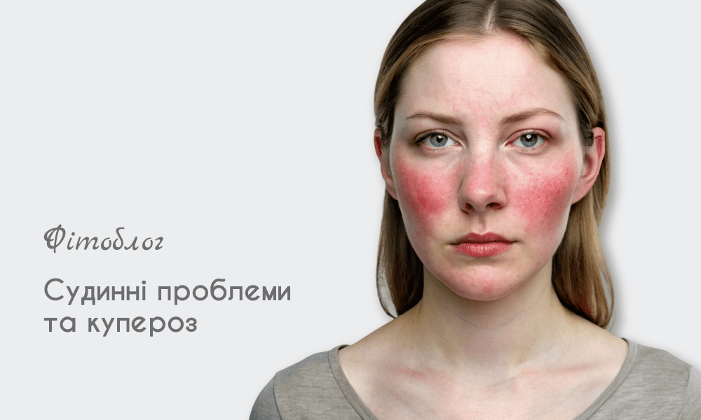 Судинні проблеми, купероз і розацеа