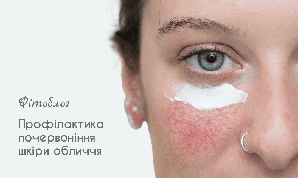Профілактика почервоніння шкіри 