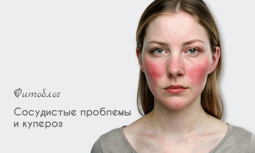 Сосудистые проблемы, купероз и розацеа