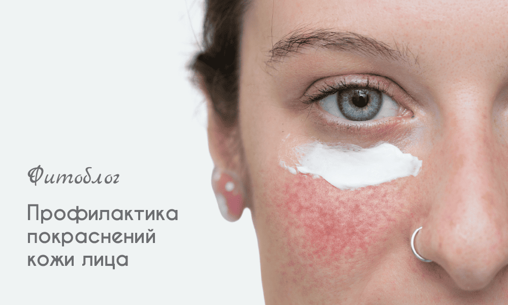 Профилактика покраснения кожи