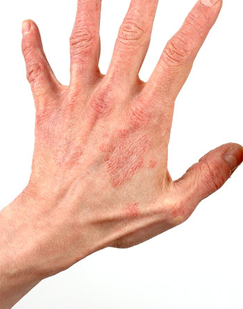 Атопический дерматит: всегда ли он связан с аллергией?