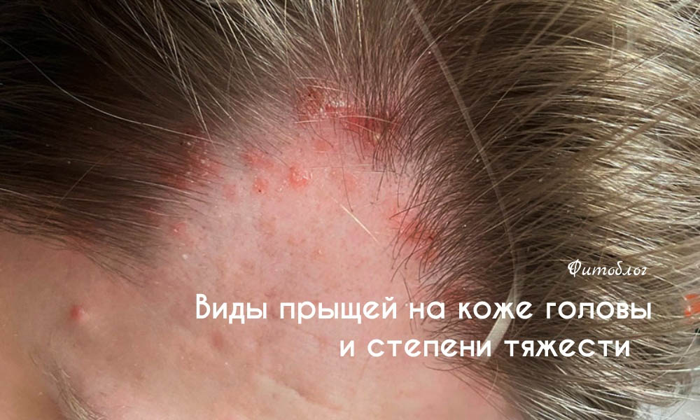 Виды прыщей на коже головы и степени тяжестит