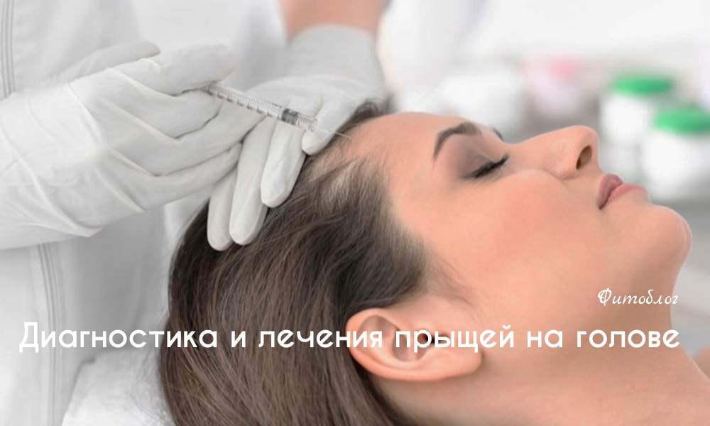 Болячки на коже головы: причины, методы лечения и рекомендации — Клиника трихологии «Cheveux»