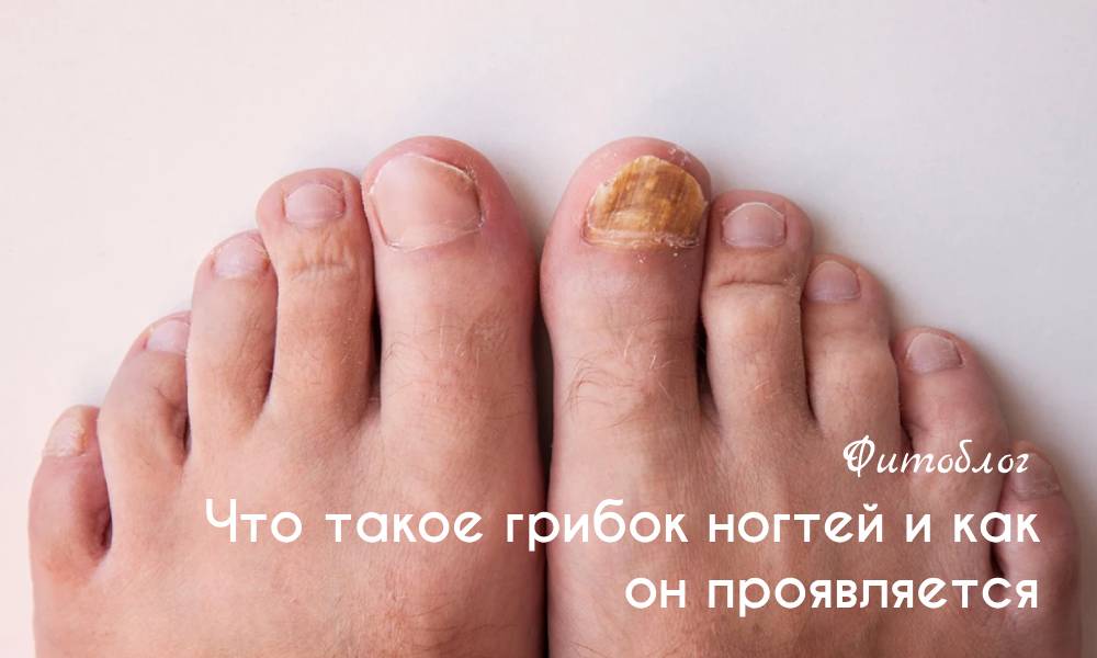 Что такое грибок ногтей и как он проявляется