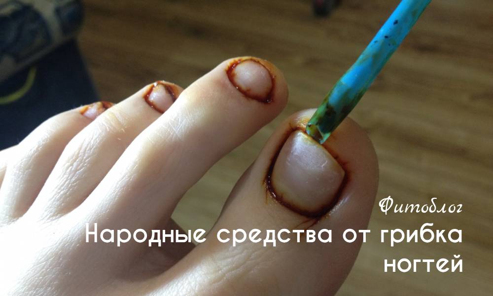Народные средства от грибка ногтей