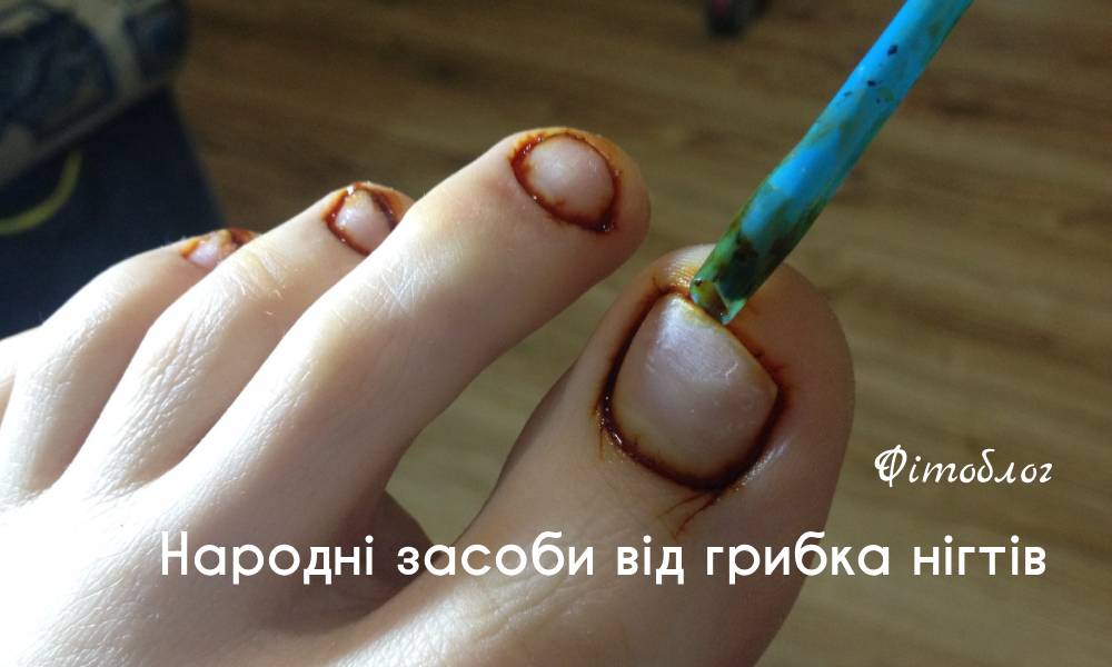 Народні засоби від грибка нігтів