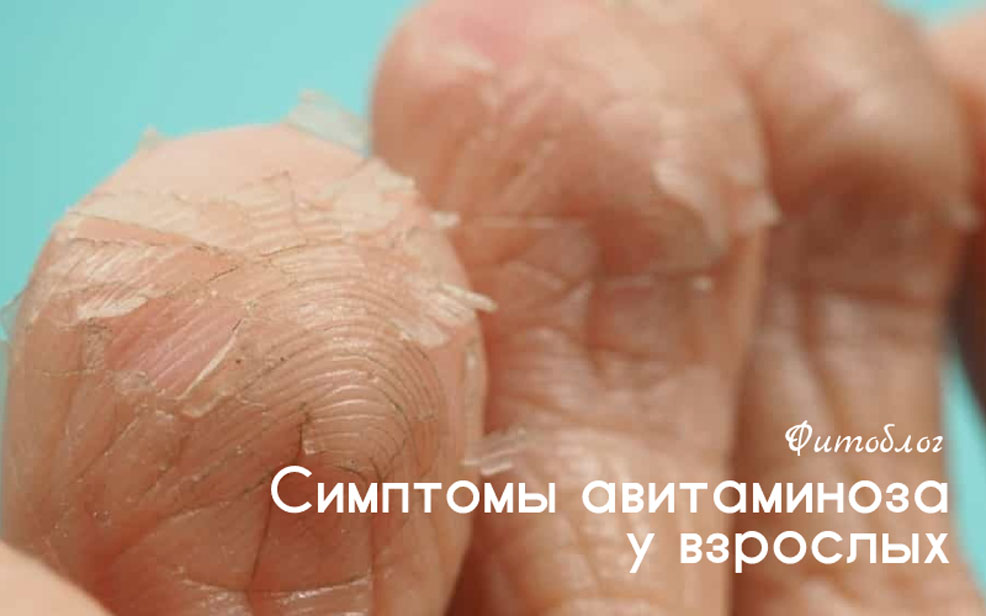 Очень сильно слоятся ногти на руках: виним авитаминоз