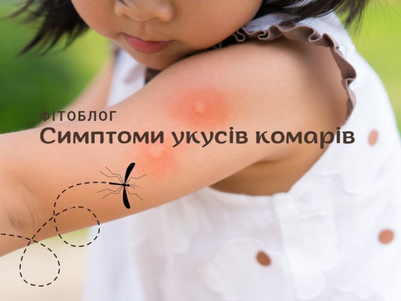 Симптоми укусів комарів