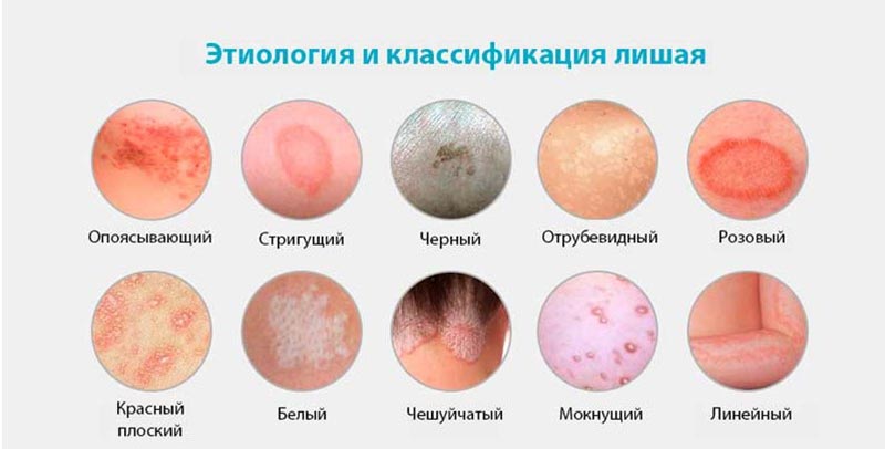 Розовый лишай (болезнь Жибера) - фото, причины, диагностика и лечение