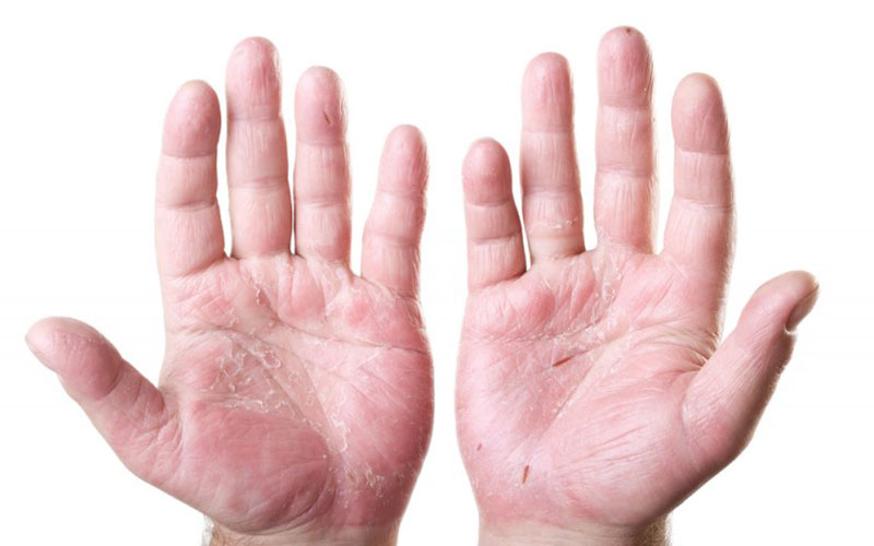 Трещины на пальцах возле ногтей – причины появления, симптомы, виды, лечение и профилактика