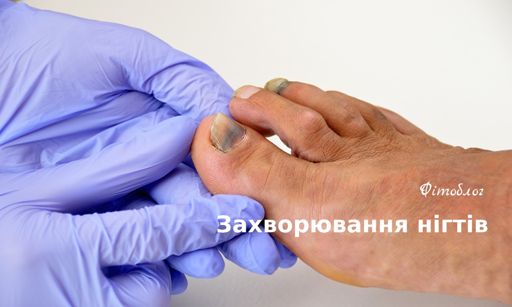 Список поширених захворювань нігтів