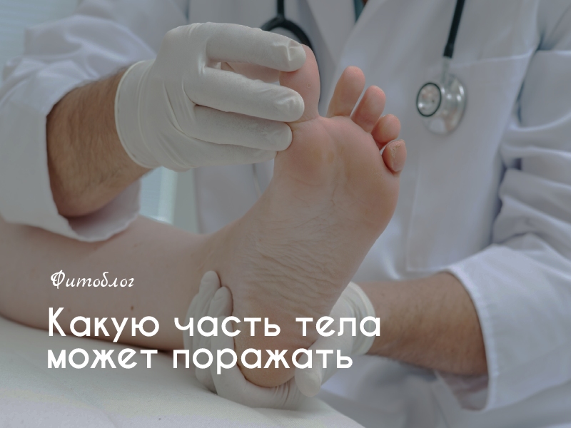 Стадии заболевания по степени поражения