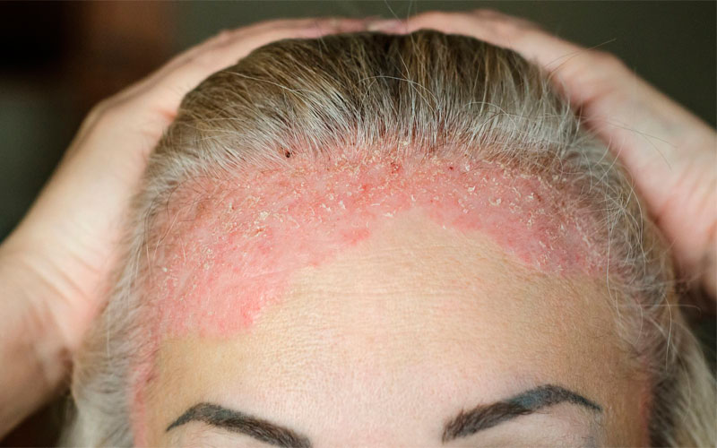 Псориаз волосистой части головы: особенности диагностики и терапии
