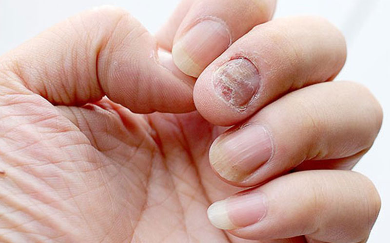 Причины пожелтения ногтей, не связанные с заболеванием:
