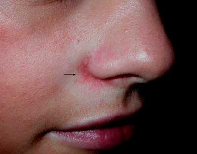 На лице сыпь: причины появления, заболевания и аллергические и угревые высыпания на коже, лечение