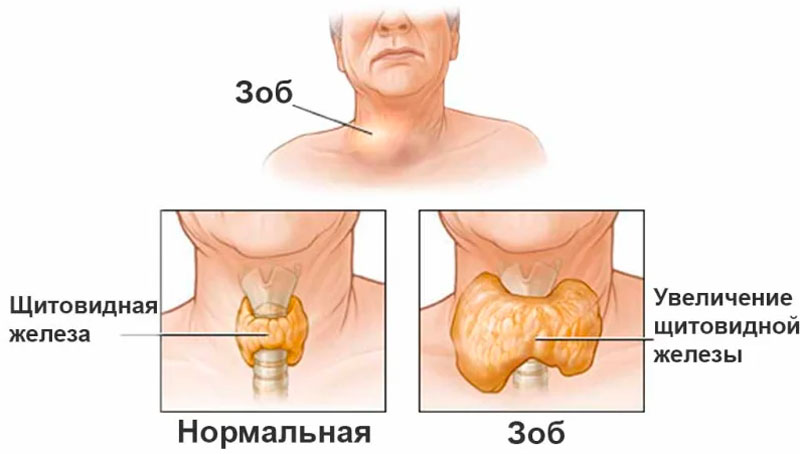 Щитовидная железа: заболевания, их симптомы и профилактика