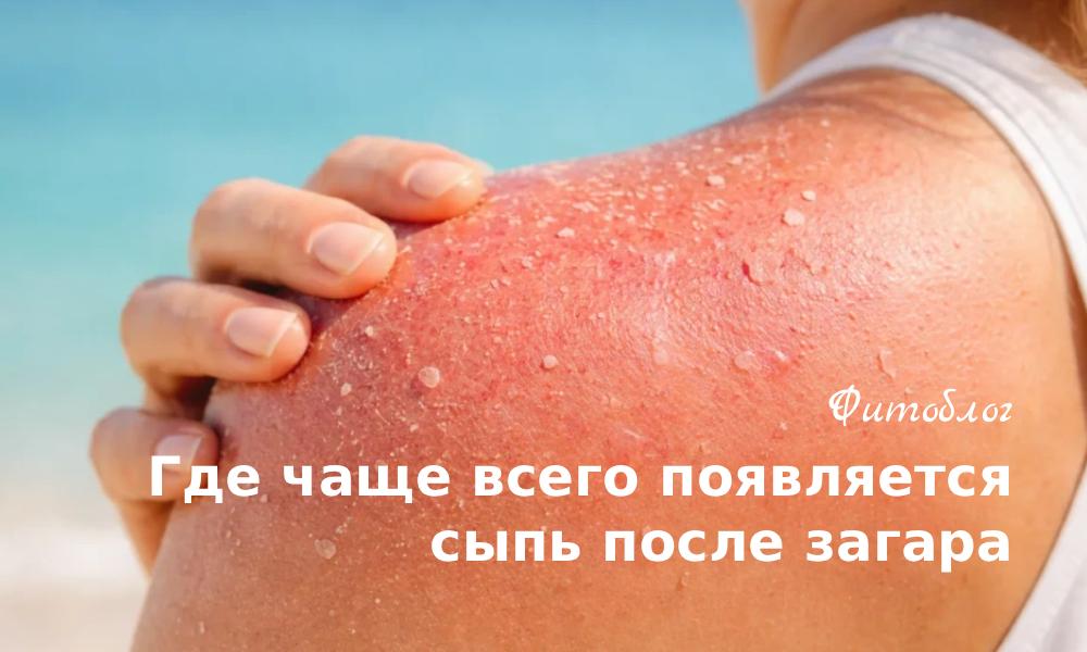 Где чаще всего появляется сыпь после загара