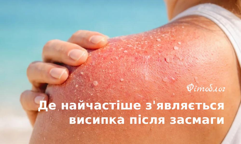 Де найчастіше з'являється висип після засмаги