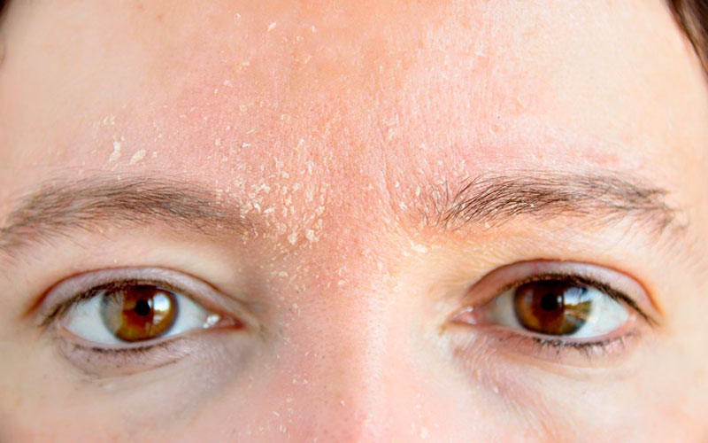 Шелушение кожи лица: почему шелушится, что делать, чтобы избавиться от проблемы - причины и лечение