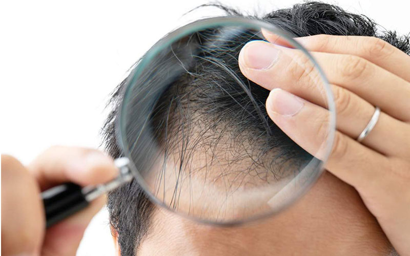 Лікування випадання волосся