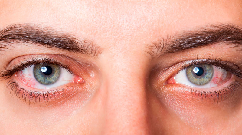 Почему опухают глаза после слез